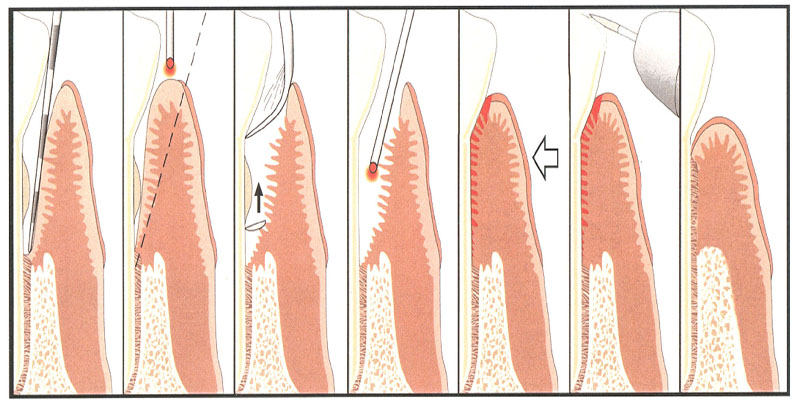 Treatment to Periodontal Disease at PERFECT SMILE